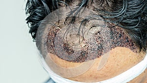 Man head with hair transplant surgery with receding hair line, FUE, Follicular unit extraction, Types of hair transplant