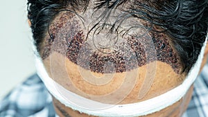 Man head with hair transplant surgery with receding hair line, FUE, Follicular unit extraction, Types of hair transplant photo