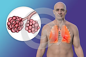 A man with healthy lungs and close-up view of lung alveoli, 3D illustration