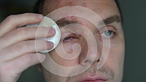 Man with herpes zoster on his face treats purulent blisters with a cotton pad