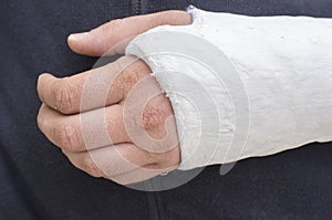 Man with his broken arm. Arm in cast.