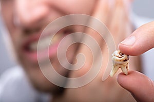 Man Holding Decayed Tooth photo
