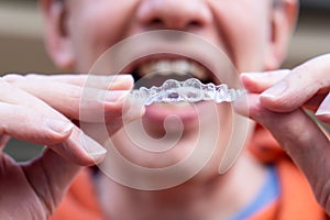 Man holding put on invisible braces. Orthodontic dental braces teeth straighteners. Gap between front teeth