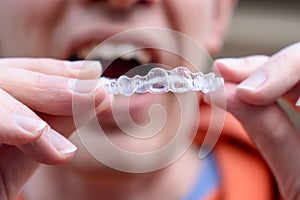 Man holding put on invisible braces. Orthodontic dental braces teeth straighteners. Gap between front teeth