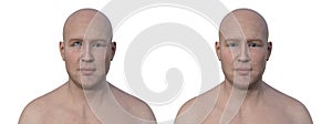 A man with hypertropia and a healthy person, 3D illustration