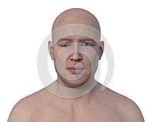 A man with hypotropia, 3D illustration