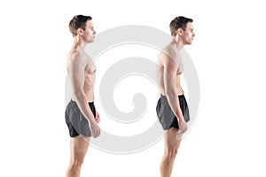 Man with impaired posture position defect