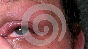 Man with infected eye