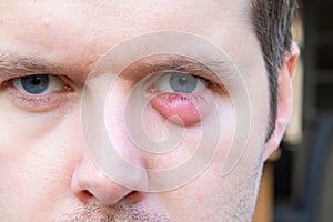 Man with an infection near his eye