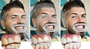 Man isolated on white teeth: before and after concept. Stomatology concept - close up of female dentist with male