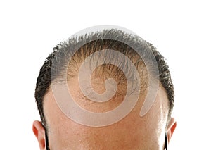 Man loosing hair, baldness photo