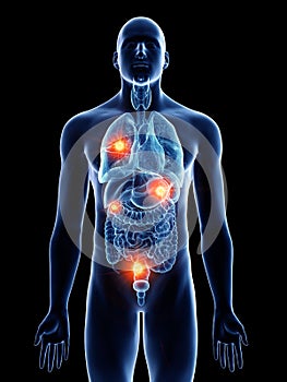 A man with metastases photo