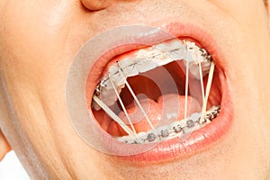 Man mouth with latex rings on braces
