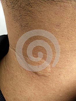 Man neck after bee stings