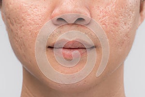 Man with oily skin and acne scars on white background