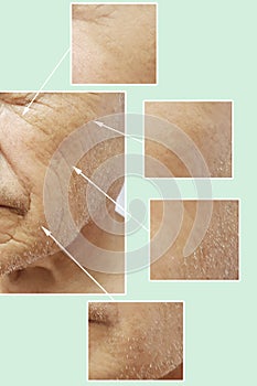 Man of old wrinkles on face before after operation surger medicine filler collagen hydrating removal, aging procedures