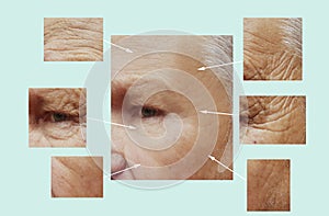 Man of old wrinkles on face before after therapy dermatology medicine filler collagen hydrating removal, aging procedures
