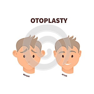 Man before and after otoplasty ear surgery treatment