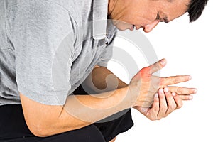 Man with painful and inflamed gout on his hand around the thumb area