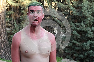 Man with pale complexion getting sunburnt