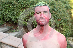 Man with pale complexion getting sunburnt