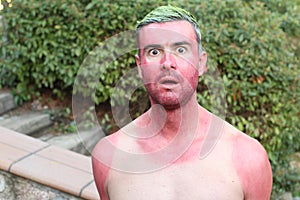 Man with pale complexion getting sunburnt