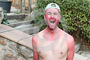 Man with pale complexion getting sunburnt