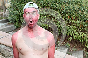 Man with pale complexion getting sunburnt