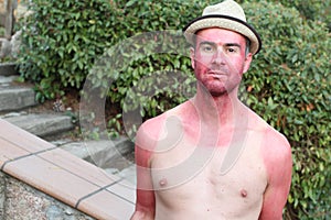 Man with pale complexion getting sunburnt