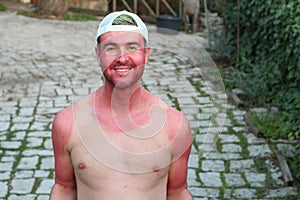 Man with pale complexion getting sunburnt