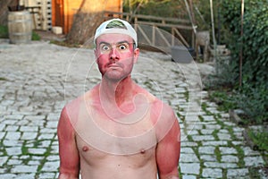 Man with pale complexion getting sunburnt