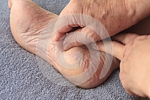 A man peeling dry skin from his foot