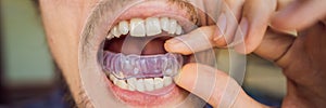 Man placing a bite plate in his mouth to protect his teeth at night from grinding caused by bruxism, close up view of