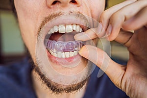 Man placing a bite plate in his mouth to protect his teeth at night from grinding caused by bruxism, close up view of photo