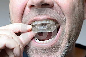 Man placing a bite plate in his mouth photo