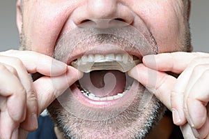 Man placing a bite plate in his mouth photo