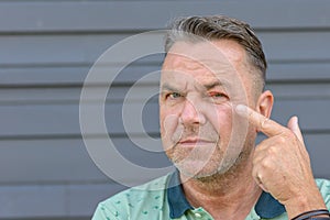 Man pointing to an inflamed eye caused by bacteria