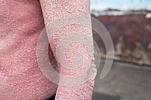 A man with psoriasis on his back and neck. Scratch with his hand. Psoriasis vulgaris skin problem