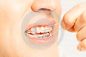 Man put latex rings on teeth for correcting bite photo