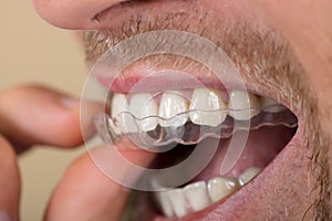 Man Putting Transparent Aligner In Teeth