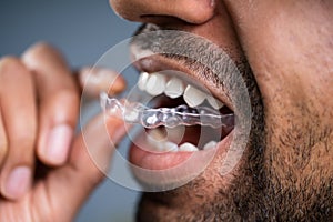 Man Putting Transparent Aligner In Teeth