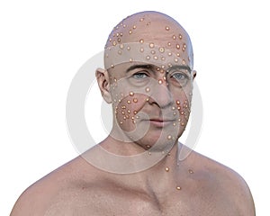 A man with rash from pox viruses, 3D illustration
