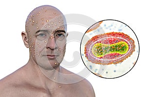 A man with rash from pox viruses, 3D illustration photo