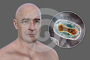 A man with rash from pox viruses, 3D illustration photo