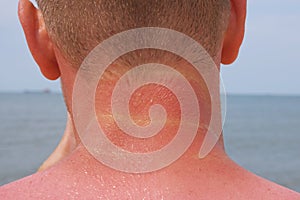 The man received sunburn on seashore. The skin peels off. Protection of the skin from the sun.