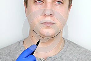 Chin lift - mentoplasty. A man at the reception at the plastic surgeon. Preparation for surgery photo