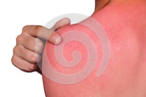 A man with reddened, itchy skin after sunburn.