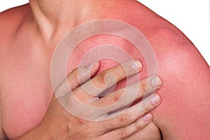 A man with reddened, itchy skin after sunburn. photo