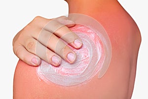 A man with reddened, itchy skin after sunburn. Skin care and protection from the sun`s ultraviolet rays. Cosmetology concept