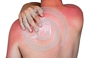 A man with reddened itchy skin after sunburn, smears cream on the skin.